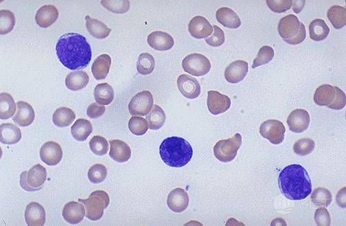 慢性淋巴细胞白血病症状,儿童淋巴细胞白血病的早期症状