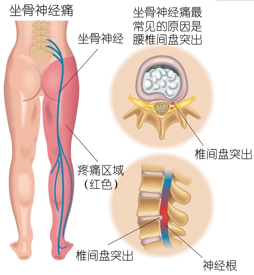 腰椎疼痛及治疗,有什么好办法不手术能治疗腰椎疼