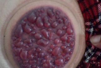 拔罐拔出血泡要不要戳破,为什么拔罐出水泡