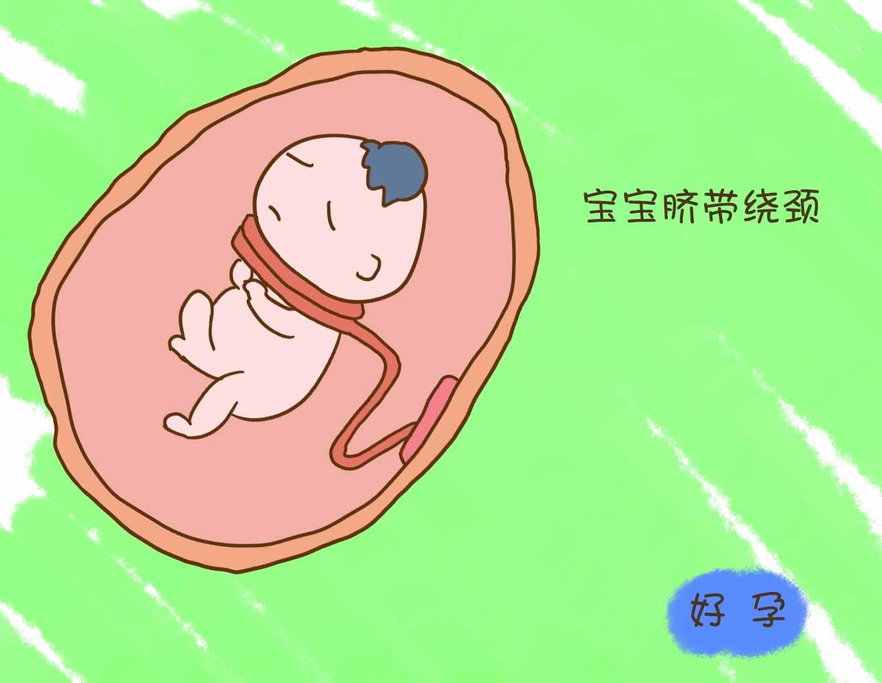 宝宝脐带绕颈两周自己又绕出来了,宝宝脐带绕颈全过程视频