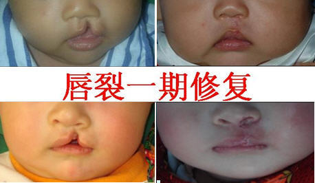 新生儿兔唇是什么原因造成的,生娃防坑指南