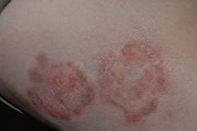 皮肤癣介绍,皮肤癣菌的介绍