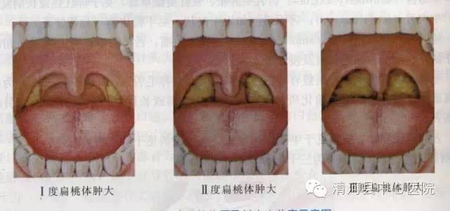 小孩扁桃体发炎切除还是不切,切扁桃体不切腺体