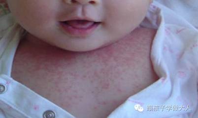 宝宝长雀斑样痣,宝宝长这种痣千万要注意