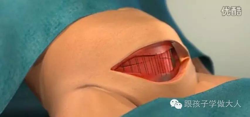 一些关于剖腹产的细节你知道多少,剖腹产最难的一个步骤