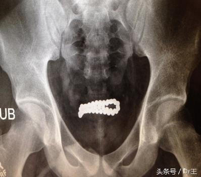 尿道插异物导致发炎,尿道长期插尿管