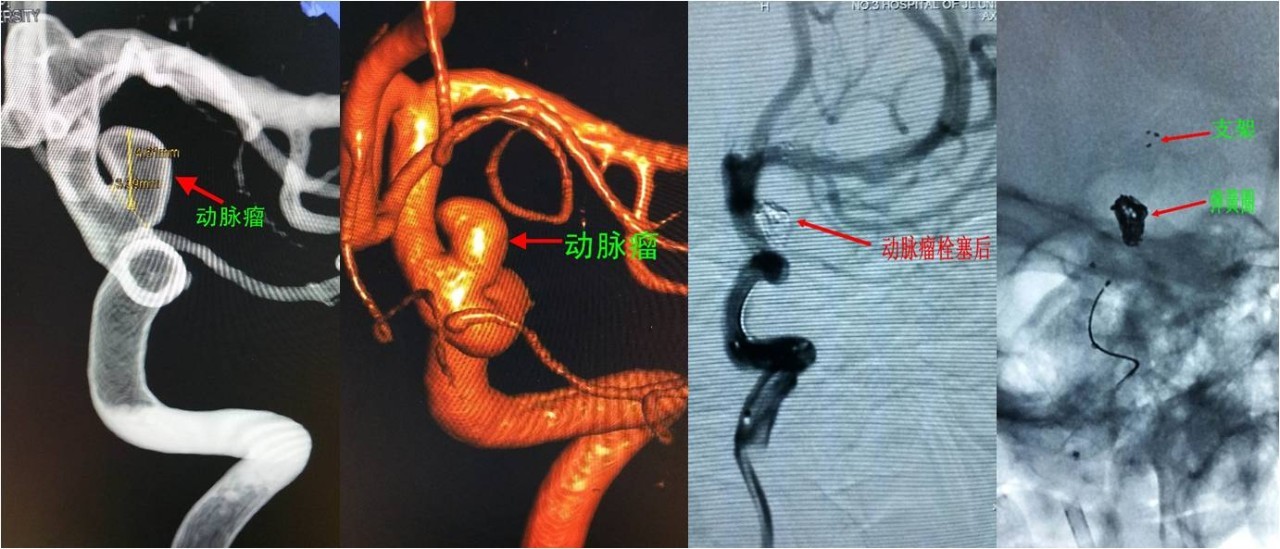 介入医学手术类视频,颈动脉介入手术病例分享