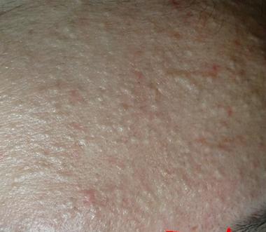 白头粉刺的形成原因及处理方法,什么是粉刺闭合性粉刺图片