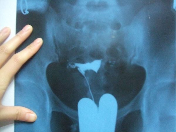 先做输卵管通水好还是造影好,刚做了输卵管通水多久可以做造影