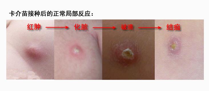 刚出生的婴儿胳膊出了一个小脓包,出生一个月的宝宝左胳膊有脓包