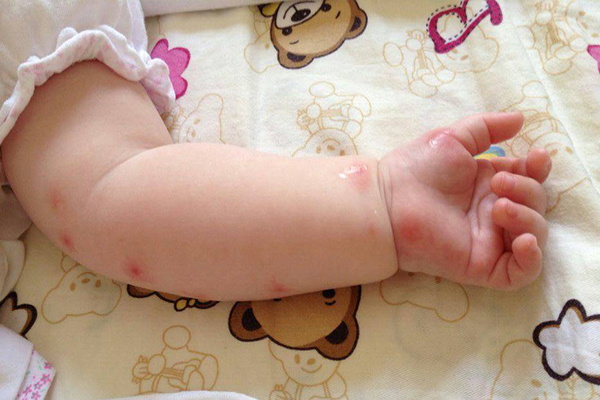 宝宝手臂红肿化脓,小孩手指有脓肿是什么病