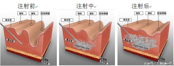 美容填充是怎么填的,脂肪填充和玻尿酸区别在哪