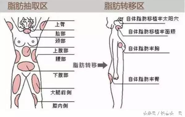美容填充是怎么填的,脂肪填充和玻尿酸区别在哪