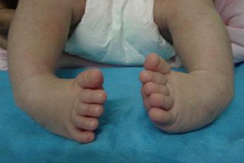 隐性脊柱裂引起尿床中医治疗方法,儿童骶1椎体隐性脊柱裂怎么治疗