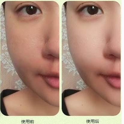 美白针没一点效果怎么样,美白针到底多久能见效呢