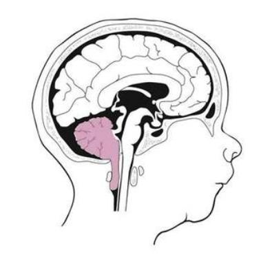chiari畸形保守治疗的效果如何,chiari畸形确诊