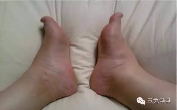 孕期浮肿不可怕，知道这些“消”掉它！