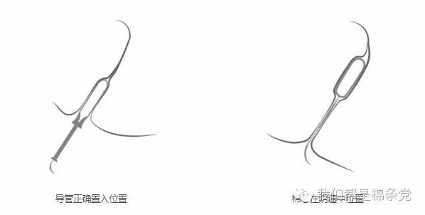 例假快结束可以下水游泳吗,例假来了游泳用棉条