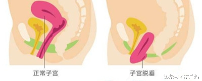 坚持做产后修复的重要性,坚持运动修复了盆底肌