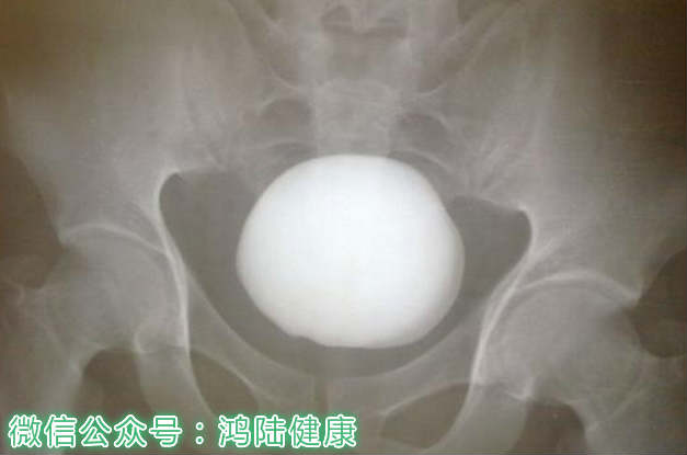 糖尿病影响肾积水和肾结石手术吗,糖尿病引起的尿潴留能治好吗