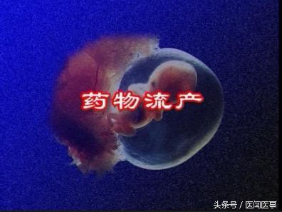 妇科门诊人流处理流程,妇科医生为什么总是建议流产