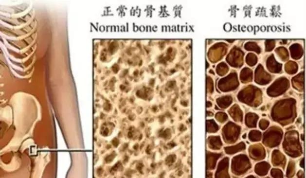 太极拳二十四式能改善骨质疏松吗,治骨质疏松运动