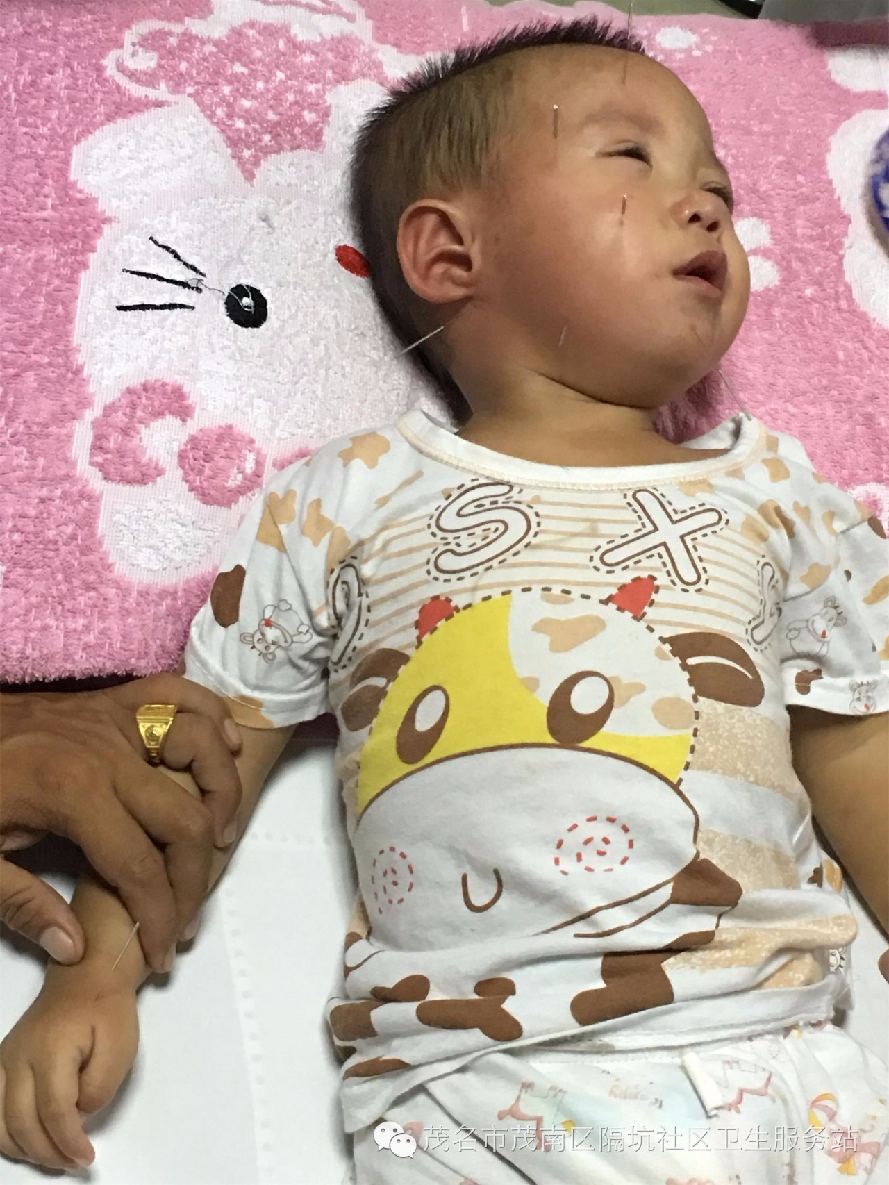 宝宝面瘫有治愈的可能吗,宝宝面瘫