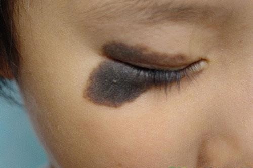 孙红雷黑色素瘤片段,孙红雷黑痣长在什么位置