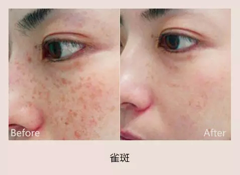 治疗雀斑为什么有的人一次恢复不反弹，有的人几次治疗都反弹