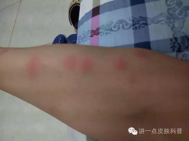 吸血臭虫叮咬症状表现,臭虫的叮咬症状有哪些
