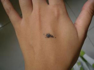 孙红雷谈黑痣长在哪里,孙红雷演的黑痣病变