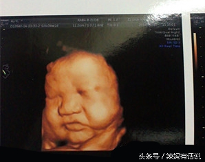 30周4还能做引产吗,34周引产的亲身经历