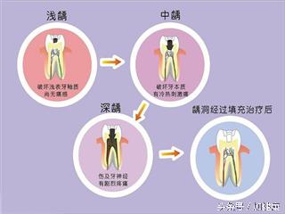 加健康收藏：有蛀牙？那就看看这篇文章吧