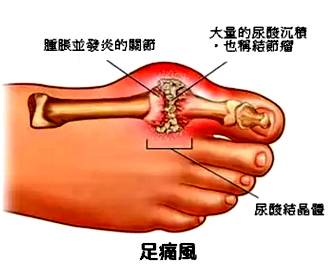 乌鸡白凤丸治痛风病吧,痛风怎么治好灵丹妙药