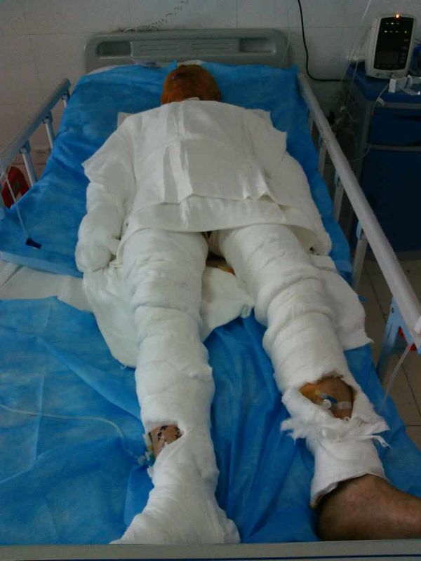 父亲大面积烧伤放弃治疗,一位6岁男孩父亲重度烧伤