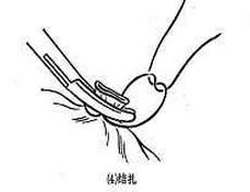 女性结扎以后复通手术全过程,女性结扎的手术步骤