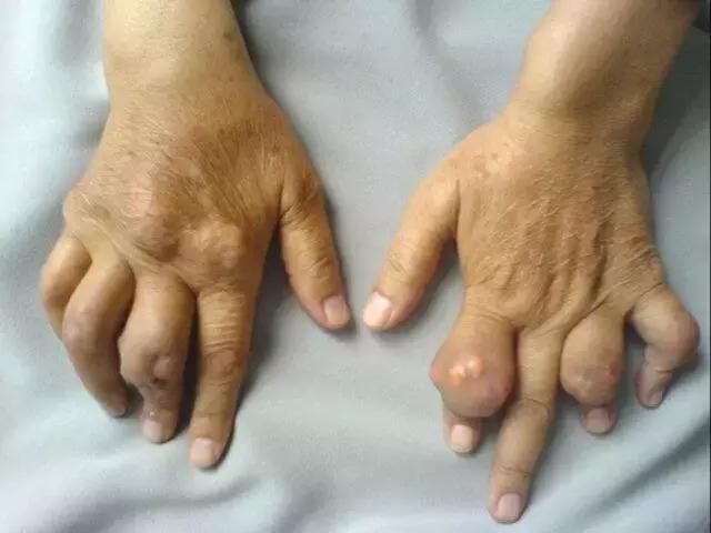 痛风到底是个什么病,痛风是什么东西在作怪