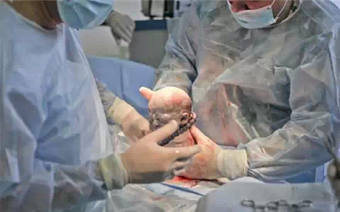 剖腹产轻松,剖腹产其实也是比较好的吧