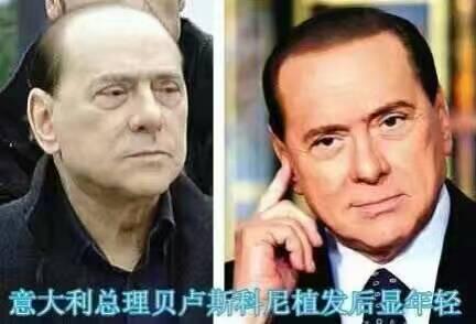 孔蒂植发效果图,孔蒂脱发