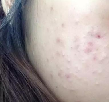 疮疡诊断要点是什么,1期压疮的护理要点