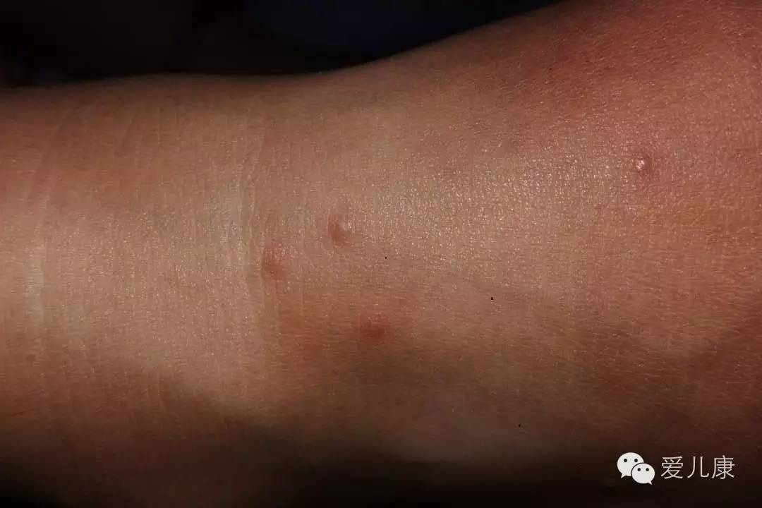宝宝手足口病腿上长满了水泡,宝宝得手足口病痘痘发痒怎么办
