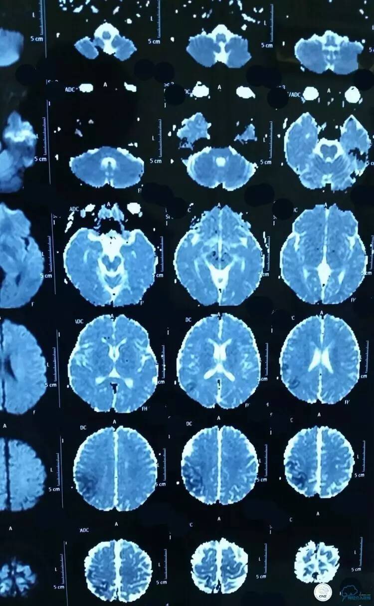 下肢血栓微创介入治疗的费用,急性深静脉血栓形成的诊断和治疗