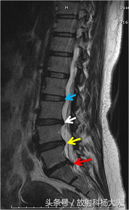 除了腰间盘突出其它哪儿都不突出,椎间盘膨出和脱出的区别