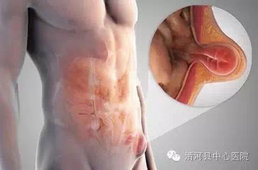 一个巨响的喷嚏过后，他被切下了小肠