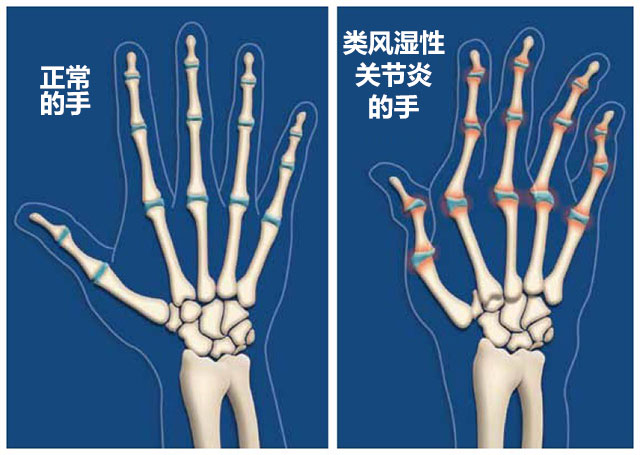 冬天没穿秋裤膝盖疼是怎么回事,不穿秋裤膝盖疼怎么回事