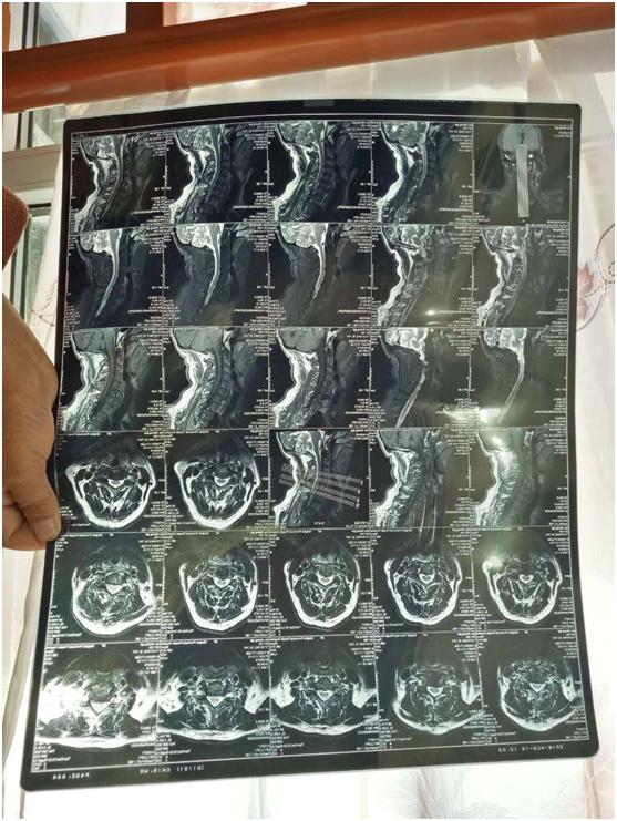 颈椎管狭窄头晕有效的中成药,颈椎管狭窄问诊