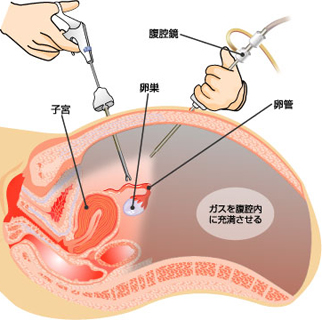 腹腔镜检查什么原理,腹腔镜的检查都有什么