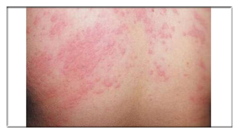 皮肤红肿瘙痒还有灼热感后起水泡,皮肤突然红肿发热瘙痒是怎么回事