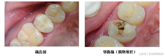 吃肉老塞牙有什么好的办法解决,吃肉老塞牙什么原因