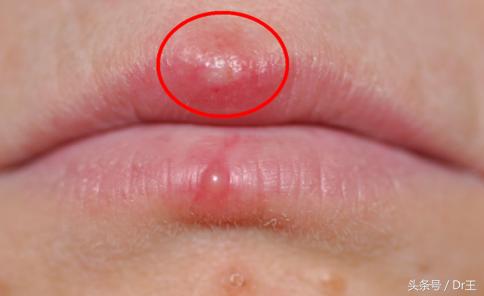 唇疱疹又痛又痒，医生:这几招可减轻发炎、加速疱疹脱落！